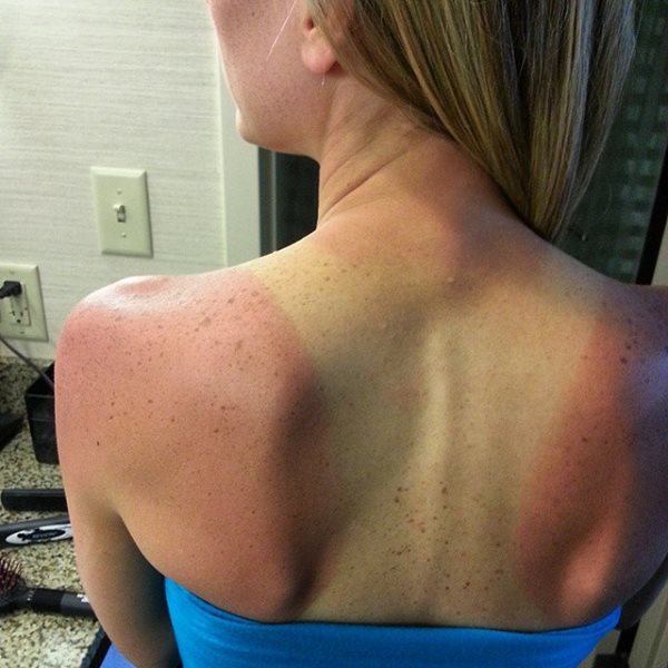 Kelley Sunburned from Kayaking